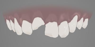 Illustration of chipped teeth