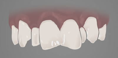 Illustration of mildly crooked teeth