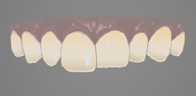 Illustration of discoloured teeth