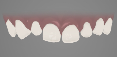 Illustration of gaps between teeth