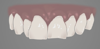 Illustration of overcrowded teeth